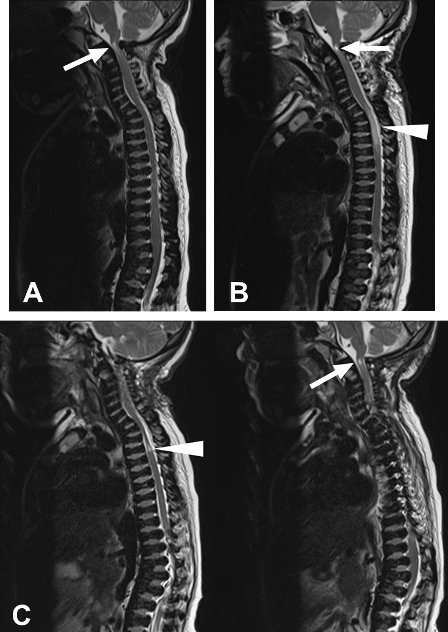 Spinal Cord Infarction Remote from Maximal Compression in a Patient with Morquio syndrome
